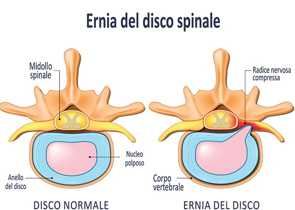 fuoriuscita di parte del nucleo polposo dalla propria sede anatomica